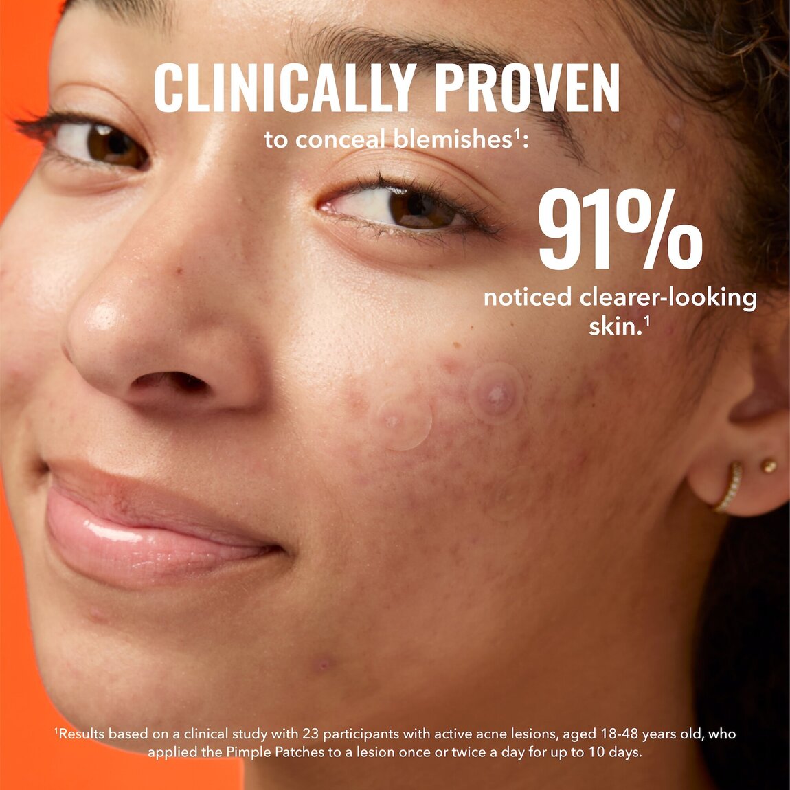 pimple-patches-e7 zb_p.jpg